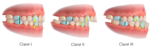 maloclusion