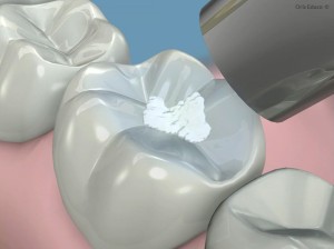 sellador-dental-
